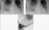 Hemodynamic Disorders, Thromboembolic Disease and Shock - MSP - 4c