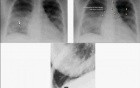 Hemodynamic Disorders, Thromboembolic Disease and Shock - MSP - 4c