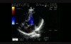 Combined Shunt: Ostium Secundum asd And Perimembranous vsd 