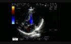 Combined Shunt: Ostium Secundum asd And Perimembranous vsd 