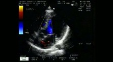 Combined Shunt: Ostium Secundum asd And Perimembranous vsd 