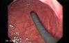 Adenocarcinoma of the Gastroesophageal Junction - Introduction of Two Endoscopes