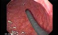 Adenocarcinoma of the Gastroesophageal Junction - Introduction of Two Endoscopes