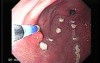 Watermelon Stomach (3 of 7) - Treatment with Argon Plasma Coagulator (APC)