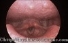Laryngeal Evaluation