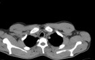 Circular resection of trachea