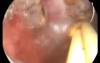 Adenomyosis - endometrial ablation