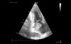 Myxoma In Echocardiography