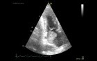 Myxoma In Echocardiography