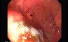 Hereditary Hemorrhagic Telangiectasia (Osler-Weber-Rendu syndrome) (5 of 7)