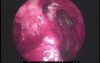 Frontal Sinus Drill-Out