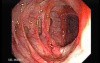 Severe case of Ischemic Colitis (10 of 19)