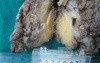 Synchronous Cancers, Familial Adenomatous Polyposis (35 of 36)
