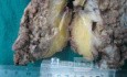 Synchronous Cancers, Familial Adenomatous Polyposis (35 of 36)