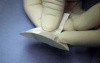Umbilical hernia repair 