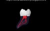 Mandibular Second Molar - Root Canal Anatomy