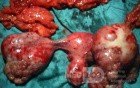 Cancer Ovary Radical Surgery