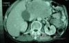 Gastric Ulcer with Gastrocolic fistula due to a Zollinger-
 Ellison Syndrome (25of 33)
