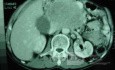 Gastric Ulcer with Gastrocolic fistula due to a Zollinger-
 Ellison Syndrome (25of 33)