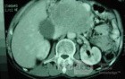 Gastric Ulcer with Gastrocolic fistula due to a Zollinger-
 Ellison Syndrome (25of 33)