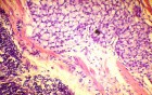 Endoscopy of Scirrhous Gastric Carcinoma involving the entire Fundus, Body and the Antrum (45 of 47)