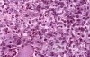 Lung Adenocarcinoma (3 of 5)