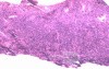 Lymphoma B small cells of the Jejuno (9 of 10)