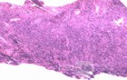 Lymphoma B small cells of the Jejuno (9 of 10)