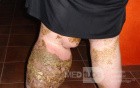 Papillary Pyoderma