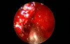 Eosinophilic Fungal Rhinosinusitis (EFRS) With Proptosis And Skull Base Erosion