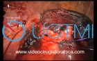 Bronchoplastic VATS right lower lobectomy lung cancer
