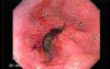 Adenocarcinoma of the Antrum with Duodenal Infiltration (2 of 3)