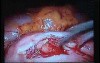 Jejunal Gastrointestinal Stromal tumor (GIST) (40 of 86)