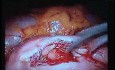 Jejunal Gastrointestinal Stromal tumor (GIST) (40 of 86)