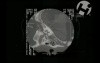 Volumated Skull and Brain