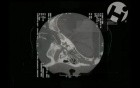 Volumated Skull and Brain