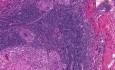 Tuberculosis