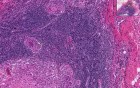 Tuberculosis
