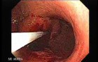 Gastrointestinal Stromal Tumor - GIST (8 of 13)