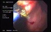 Gastric Carcinoma - Argon Plasma Coagulation (APC) Treatment (6 of 8)