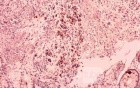 Gastrointestinal Stromal Tumour of the Rectum (4 of 5)