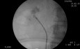 RIRS - Lower Pole Stone