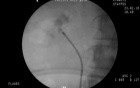 RIRS - Lower Pole Stone