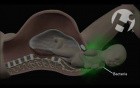 Infection Through Birth