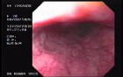 Hemorrhage Due Status Post Rubber Band Ligation of Esophageal Varices - Source of Bleeding, Part 2