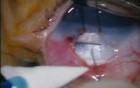 Trabeculectomy For Congenital Glaucoma