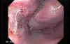 Long Standing Alcohol Abuse - Endoscopy One Week After Ligation