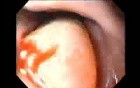 Severe Epistaxis - Case Study  (5 of 8)