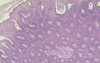 Case on Multiple Adenomas (large polyps) of the Rectum (32 of 37)