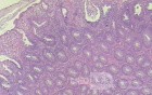 Case on Multiple Adenomas (large polyps) of the Rectum (32 of 37)